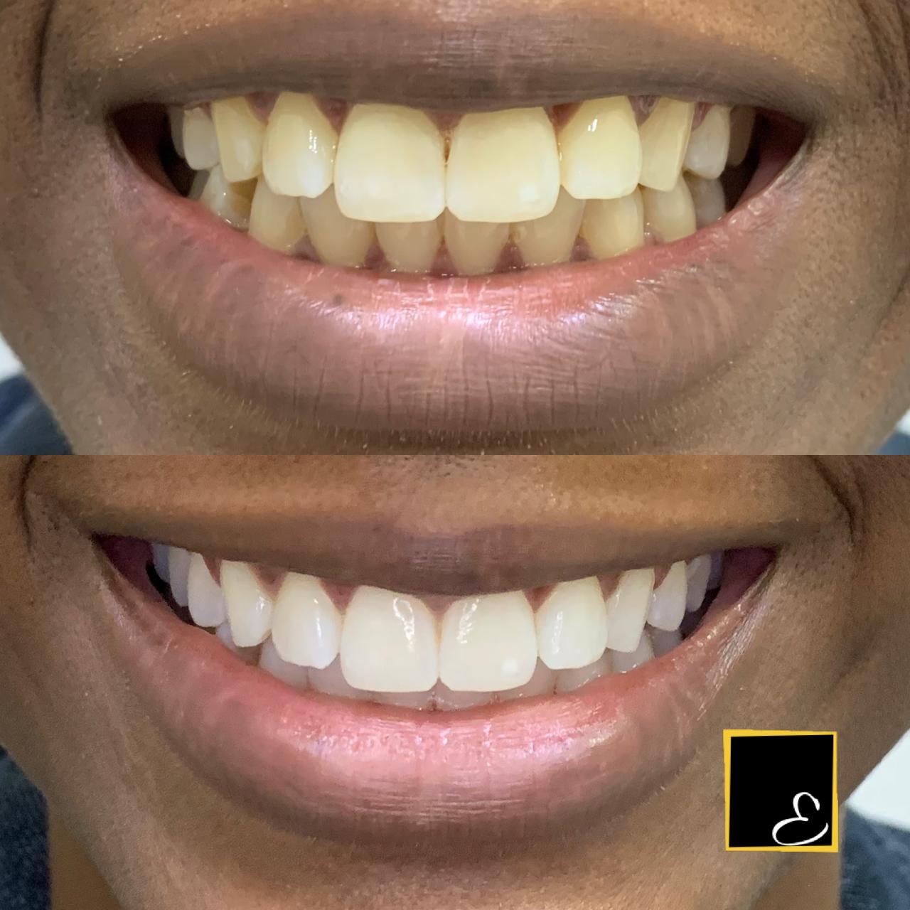 Caso real de clareamento dental - Iara
